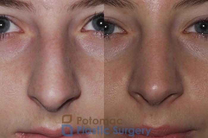 Before & After Rhinoplasty - Cosmetic Case 207 Front View in Washington DC & Arlington , DC