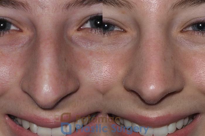 Before & After Rhinoplasty - Cosmetic Case 207 Front View #2 View in Washington DC & Arlington , DC