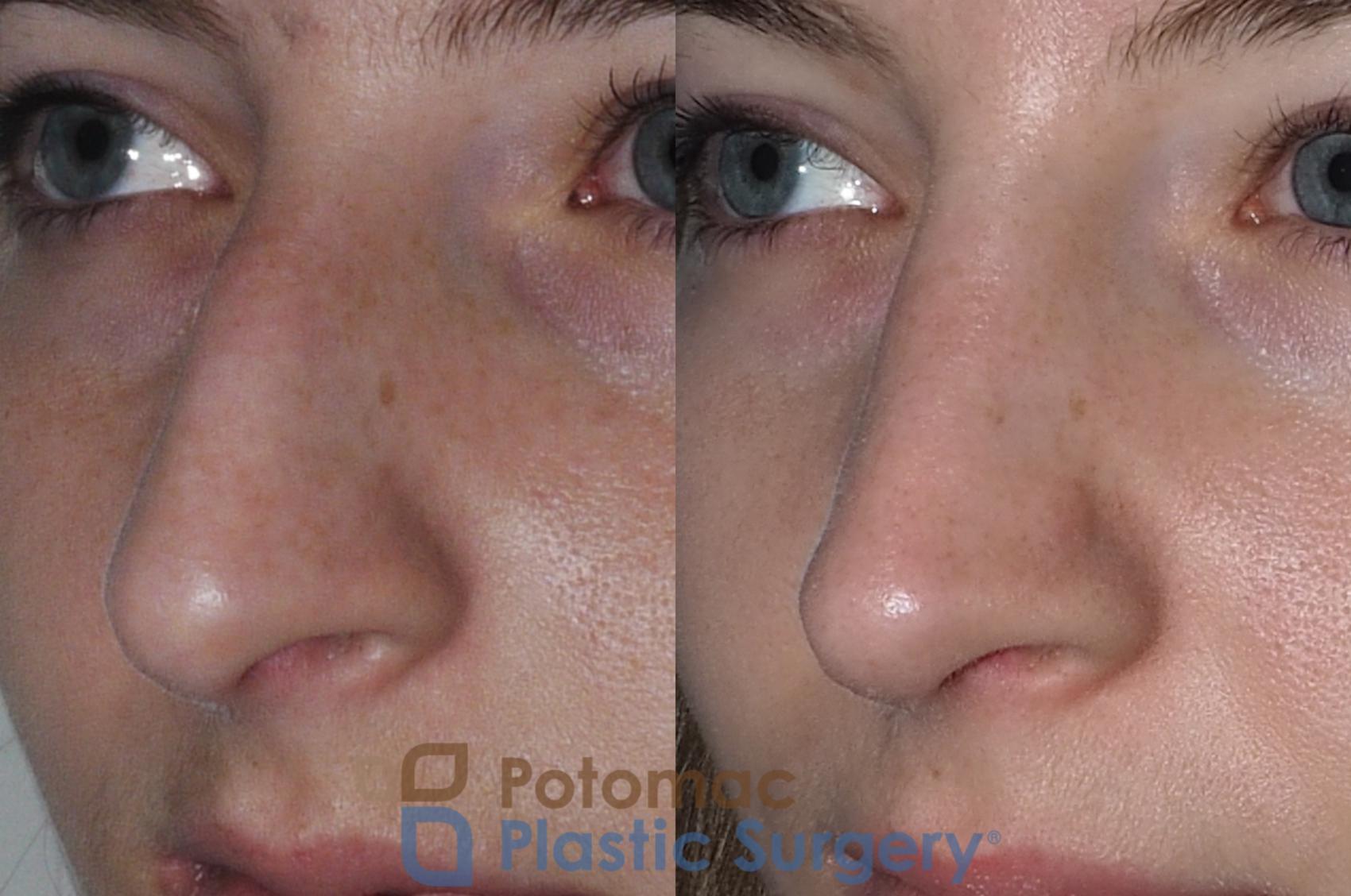 Before & After Rhinoplasty - Cosmetic Case 207 Left Oblique View in Washington DC & Arlington , DC