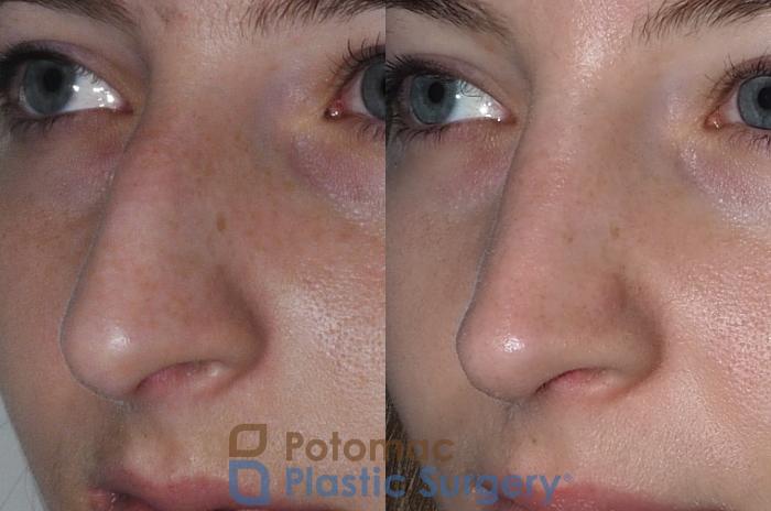 Before & After Rhinoplasty - Cosmetic Case 207 Left Oblique View in Washington DC & Arlington , DC