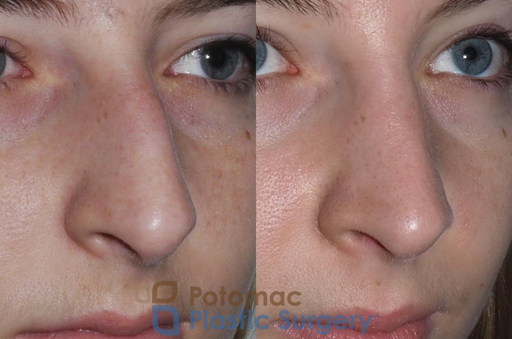 Before & After Rhinoplasty - Cosmetic Case 207 Right Oblique View in Washington DC & Arlington , DC