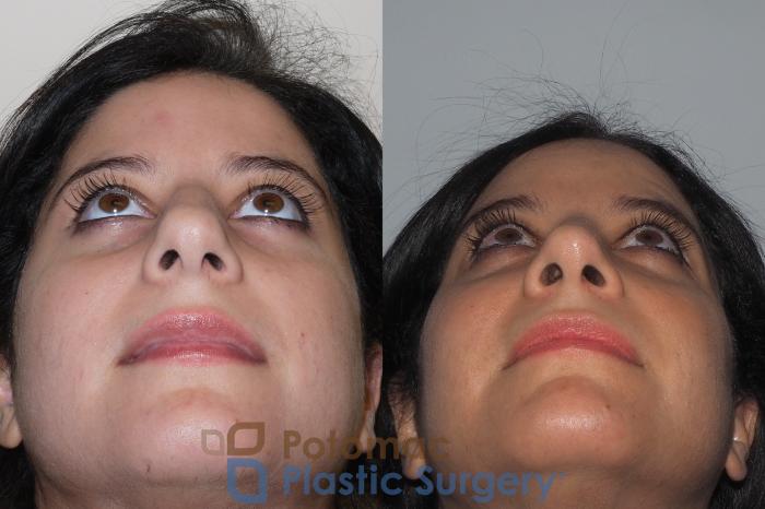 Before & After Rhinoplasty - Medical Case 212 Bottom View in Washington DC & Arlington , DC