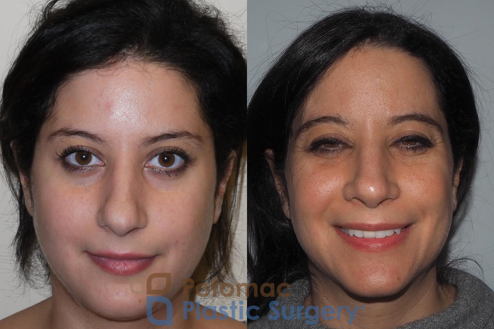 Before & After Rhinoplasty - Cosmetic Case 212 Front View in Washington, DC