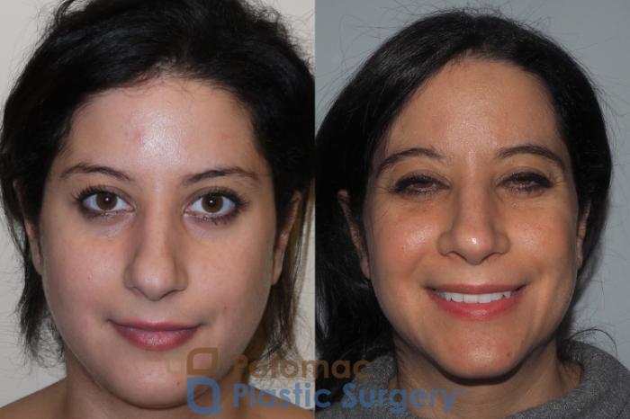 Before & After Rhinoplasty - Cosmetic Case 212 Front View in Washington DC & Arlington , DC