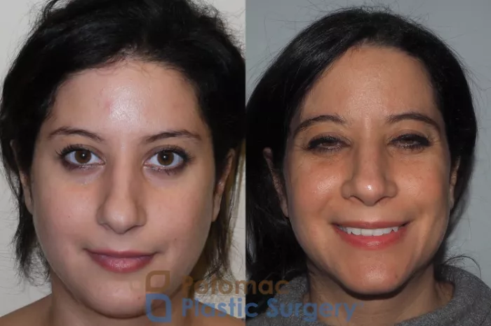 rhinoplasty-cosmetic-212-front