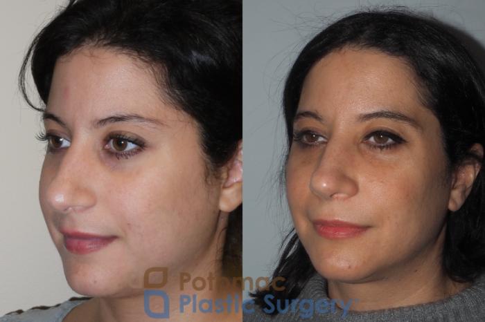 Before & After Rhinoplasty - Medical Case 212 Left Oblique View in Washington DC & Arlington , DC