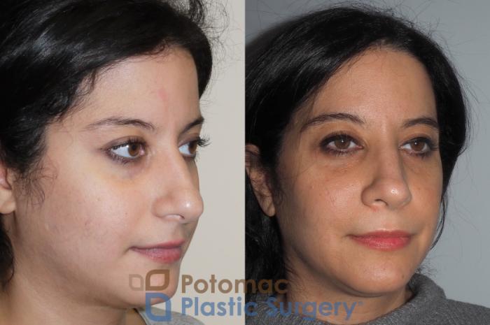 Before & After Rhinoplasty - Cosmetic Case 212 Right Oblique View in Washington DC & Arlington , DC
