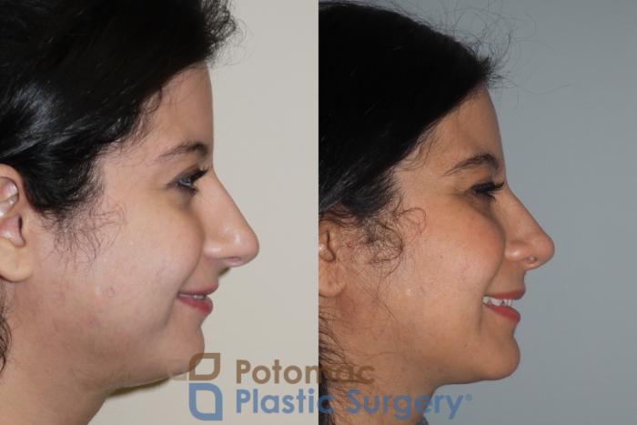 Before & After Rhinoplasty - Cosmetic Case 212 Right Side View in Washington DC & Arlington , DC