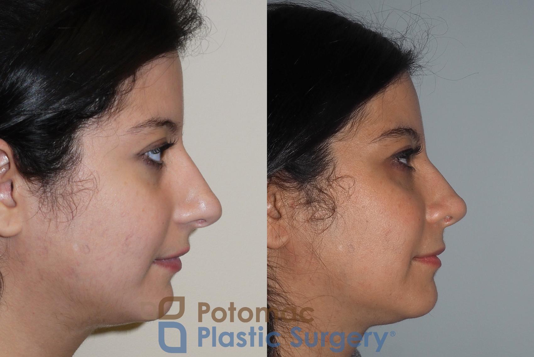 Before & After Rhinoplasty - Cosmetic Case 212 Right Side View #1 View in Washington DC & Arlington , DC