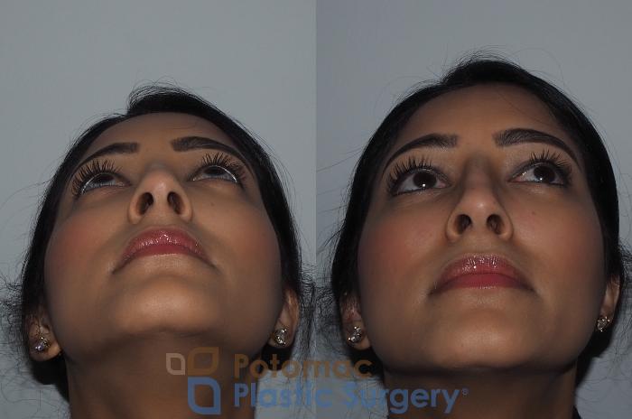Before & After Rhinoplasty - Cosmetic Case 216 Bottom View in Washington DC & Arlington , DC