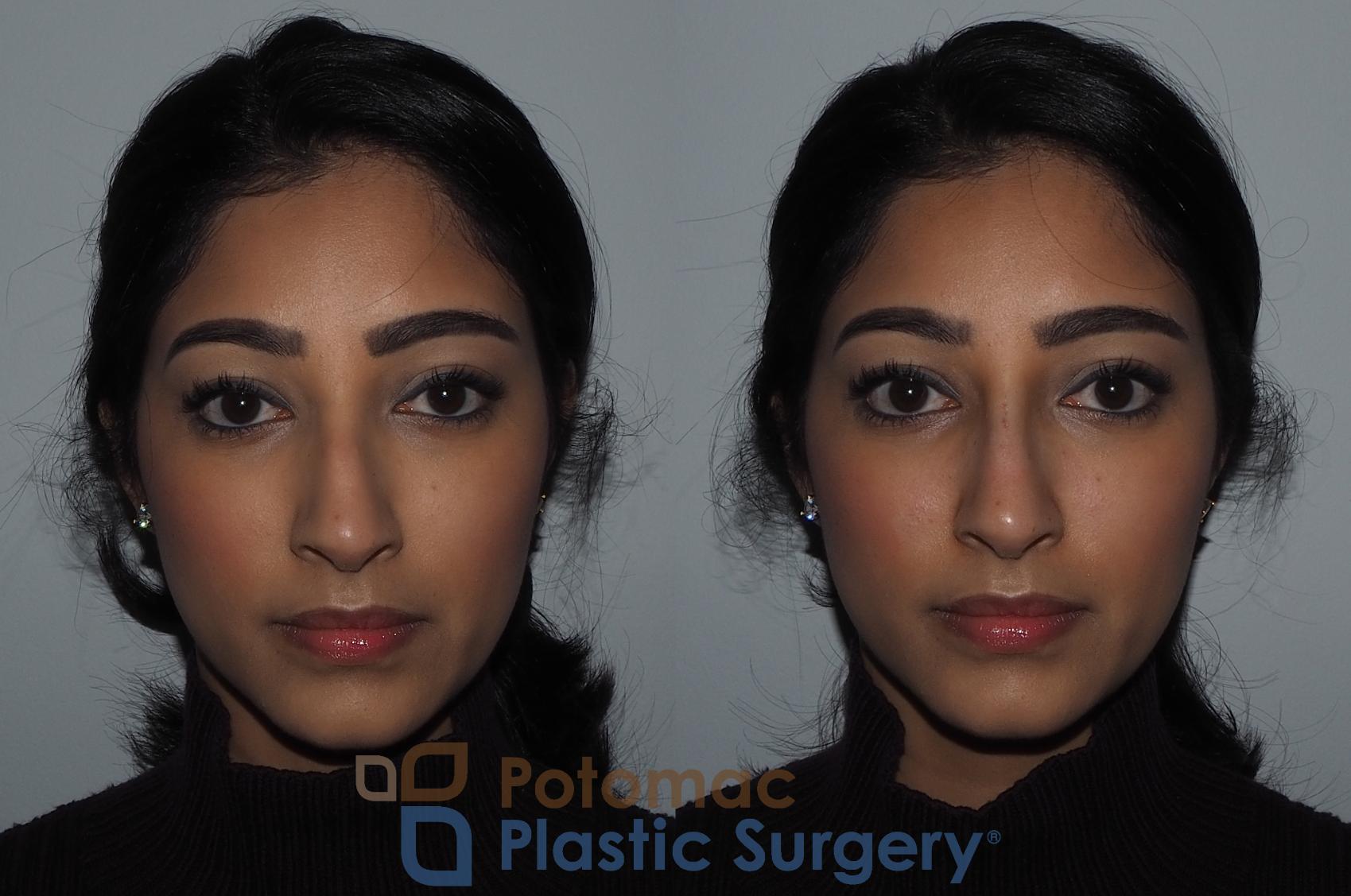 Before & After Dermal Fillers Case 216 Front View in Washington, DC
