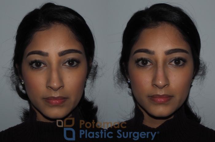 Before & After Dermal Fillers Case 216 Front View in Washington DC & Arlington , DC