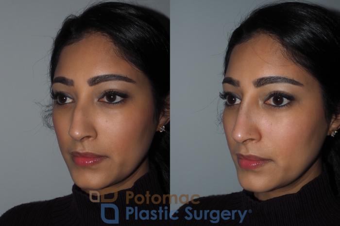 Before & After Rhinoplasty - Cosmetic Case 216 Left Oblique View in Washington DC & Arlington , DC