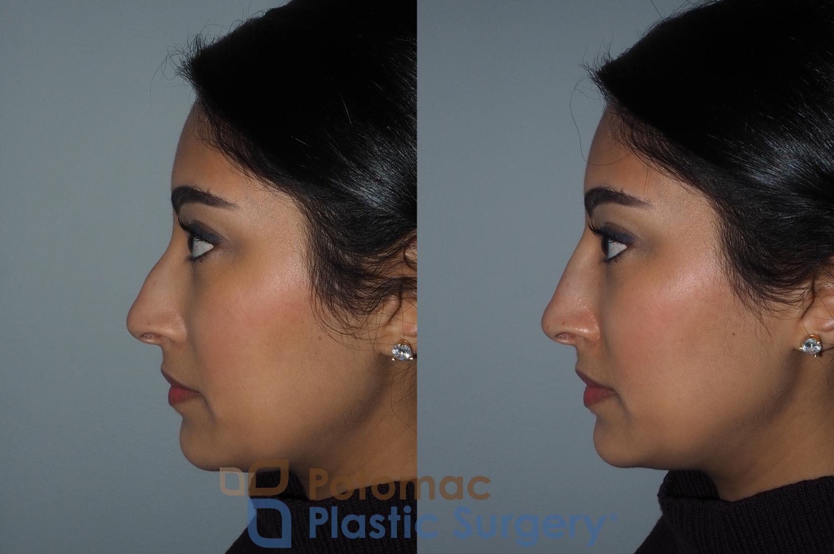 Before & After Dermal Fillers Case 216 Left Side View in Washington DC & Arlington , DC
