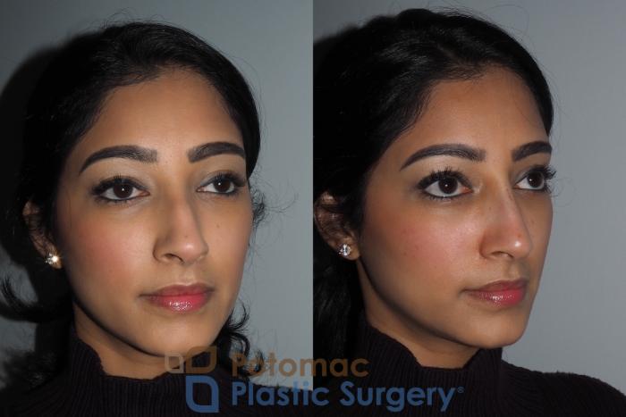 Before & After Dermal Fillers Case 216 Right Oblique View in Washington DC & Arlington , DC