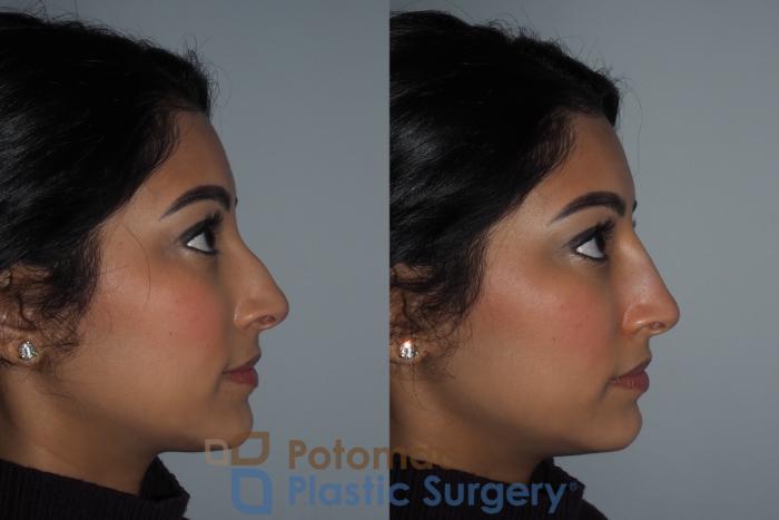 Before & After Rhinoplasty - Cosmetic Case 216 Right Side View in Washington DC & Arlington , DC