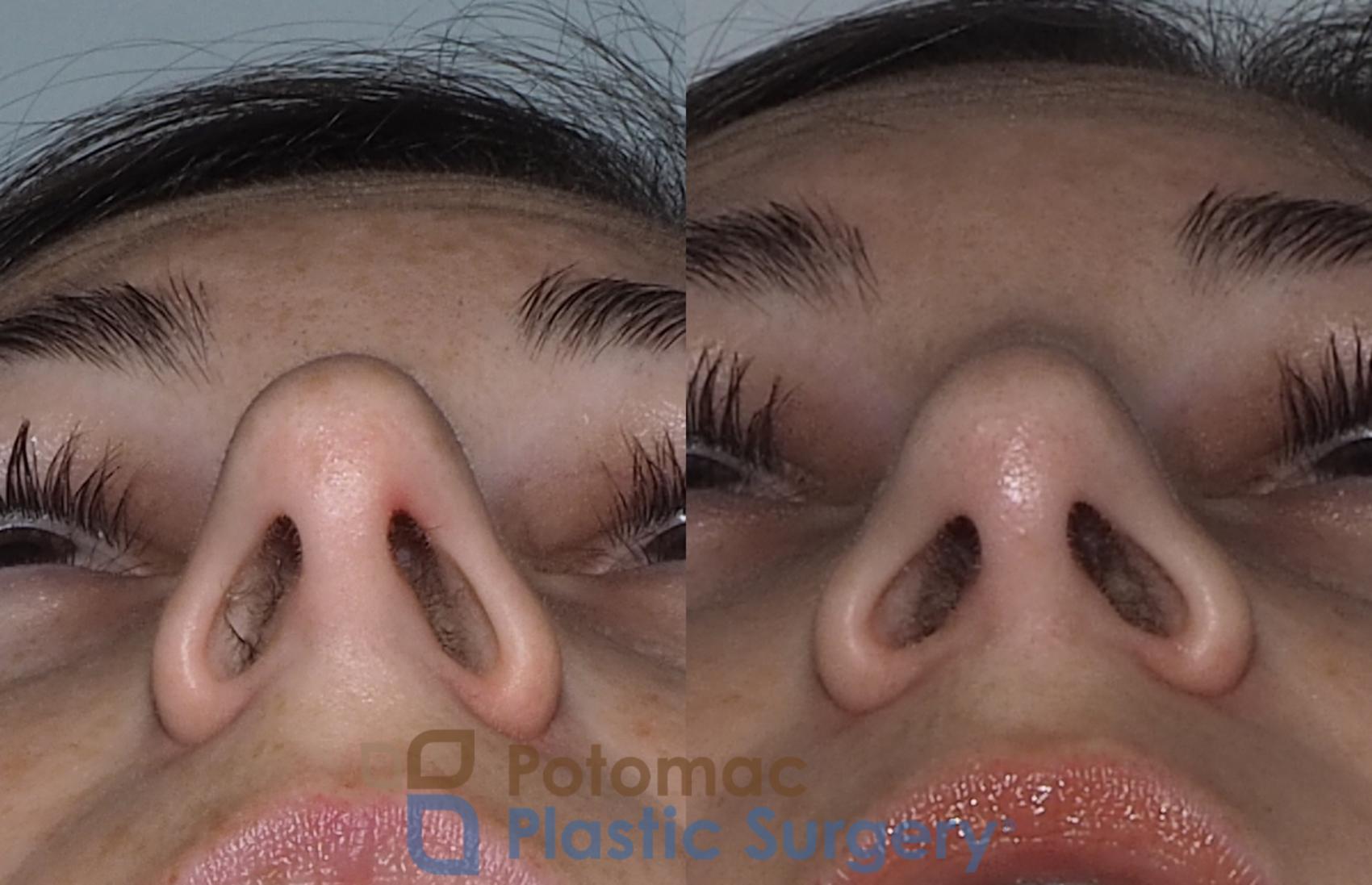 Before & After Rhinoplasty - Cosmetic Case 219 Bottom View in Washington DC & Arlington , DC