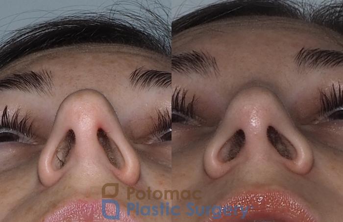 Before & After Rhinoplasty - Medical Case 219 Bottom View in Washington DC & Arlington , DC