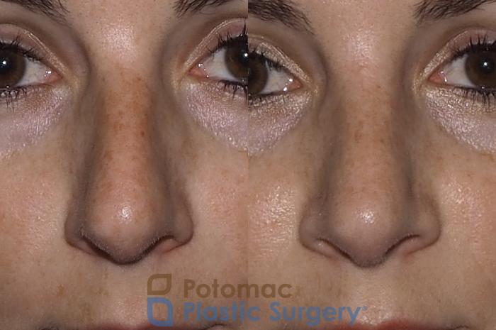 Before & After Rhinoplasty - Cosmetic Case 219 Front View in Washington DC & Arlington , DC