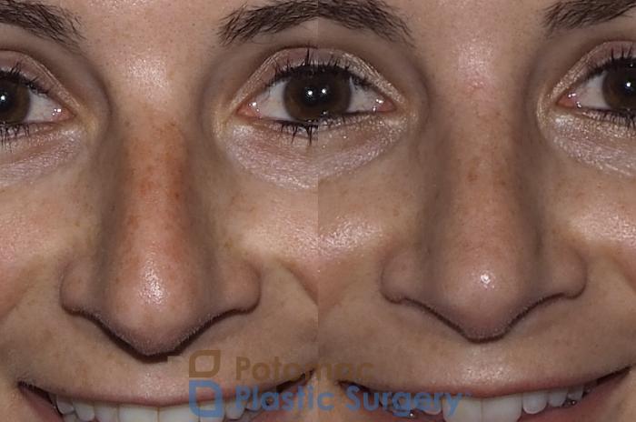 Before & After Rhinoplasty - Cosmetic Case 219 Front View #2 View in Washington DC & Arlington , DC