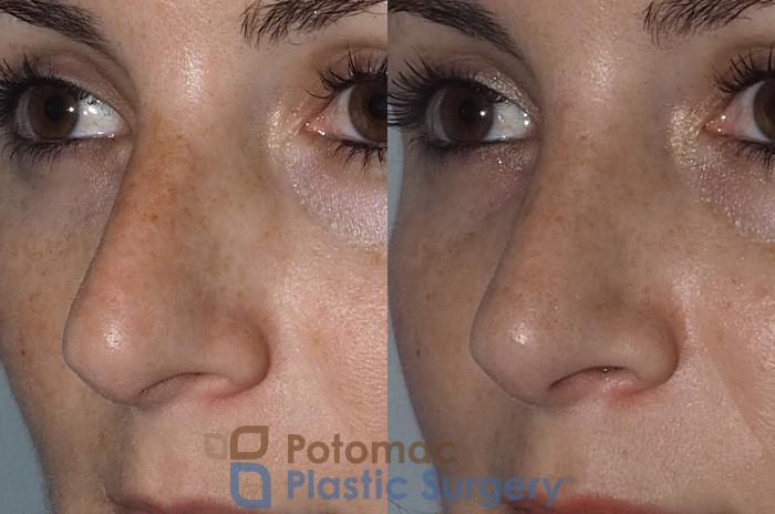 Before & After Rhinoplasty - Medical Case 219 Left Oblique View in Washington DC & Arlington , DC
