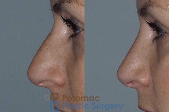 Before & After Rhinoplasty - Cosmetic Case 219 Left Side View in Washington DC & Arlington , DC