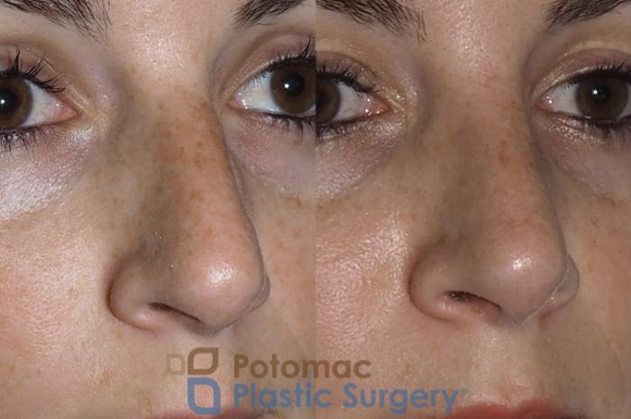 Before & After Rhinoplasty - Medical Case 219 Right Oblique View in Washington DC & Arlington , DC