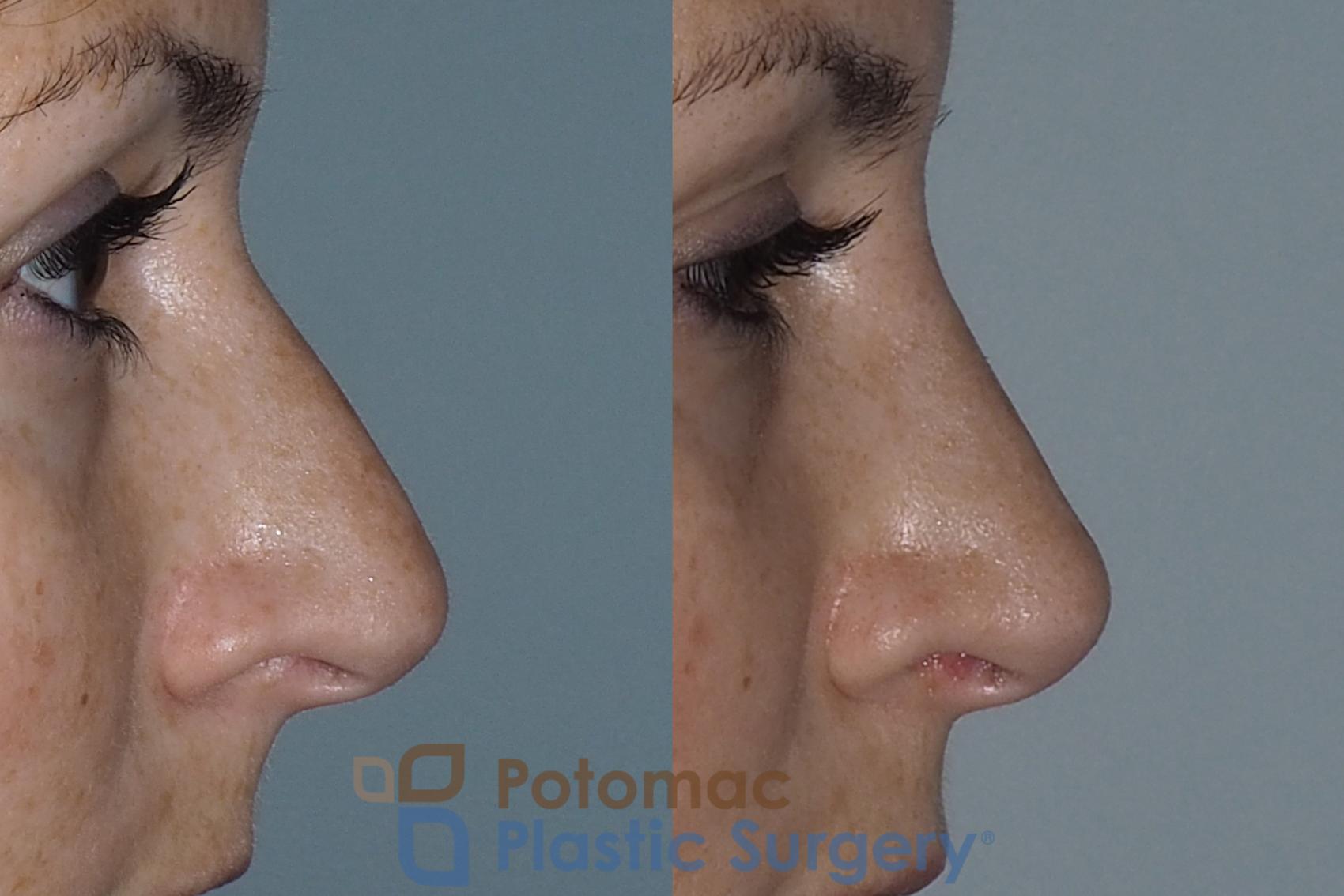 Before & After Rhinoplasty - Cosmetic Case 219 Right Side View in Washington DC & Arlington , DC