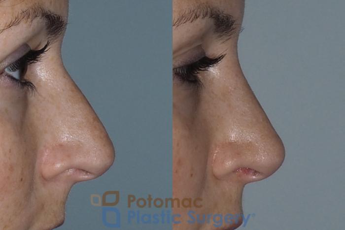 Before & After Rhinoplasty - Medical Case 219 Right Side View in Washington DC & Arlington , DC