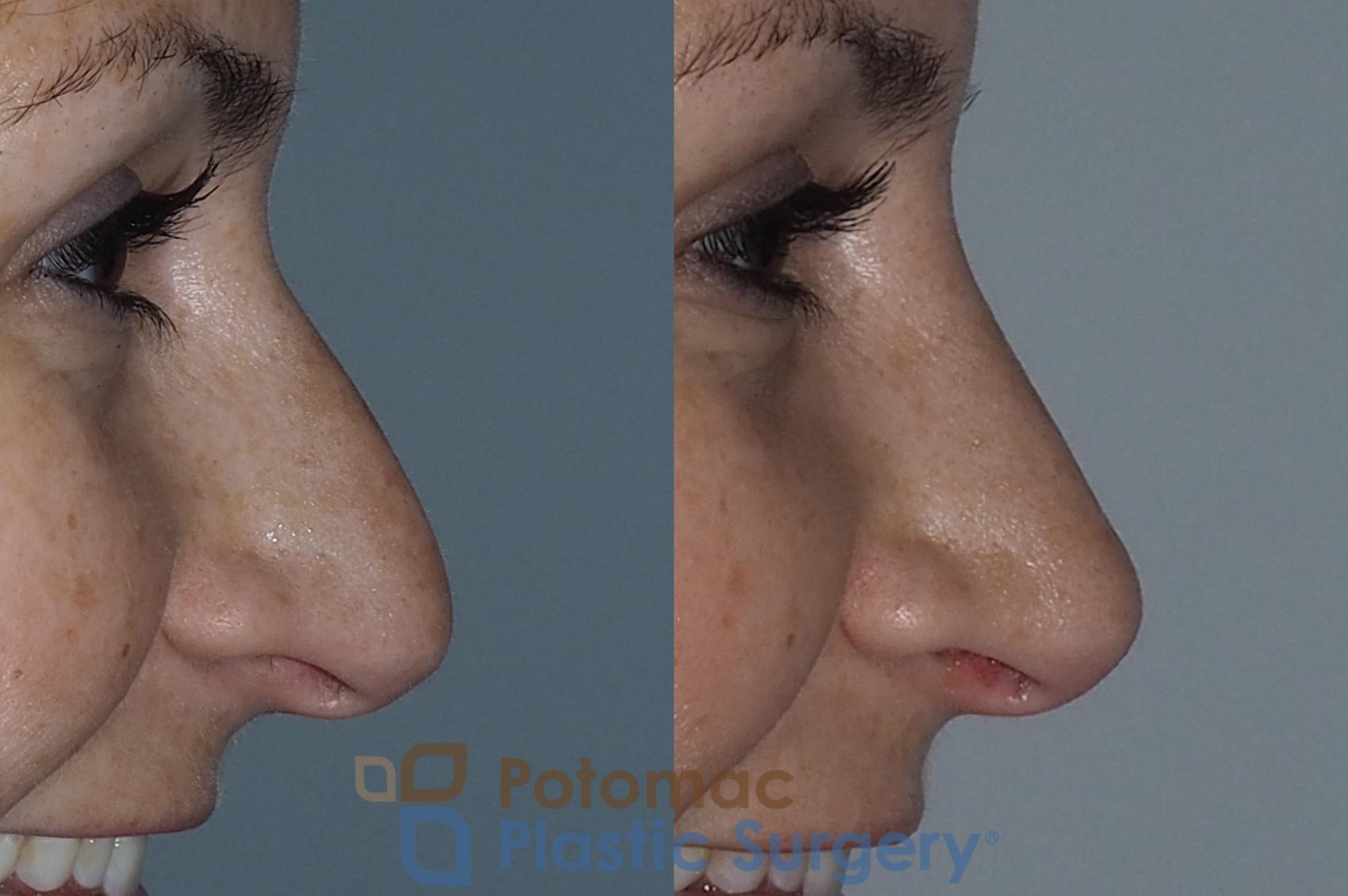 Before & After Rhinoplasty - Cosmetic Case 219 Right Side View #2 View in Washington DC & Arlington , DC