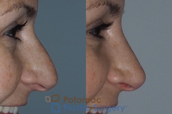 Before & After Rhinoplasty - Medical Case 219 Right Side View #2 View in Washington DC & Arlington , DC