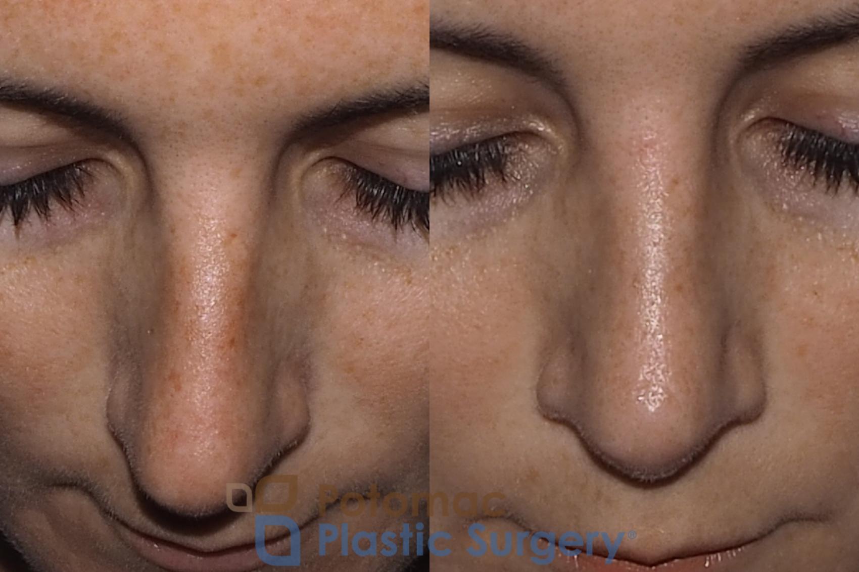 Before & After Rhinoplasty - Cosmetic Case 219 Top View in Washington DC & Arlington , DC