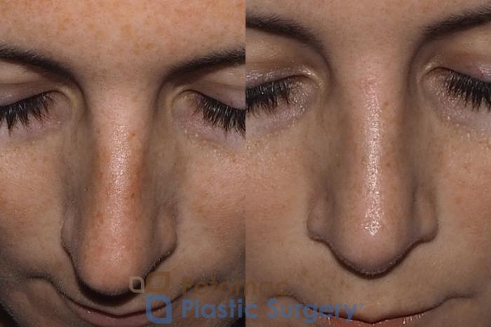 Before & After Rhinoplasty - Medical Case 219 Top View in Washington DC & Arlington , DC