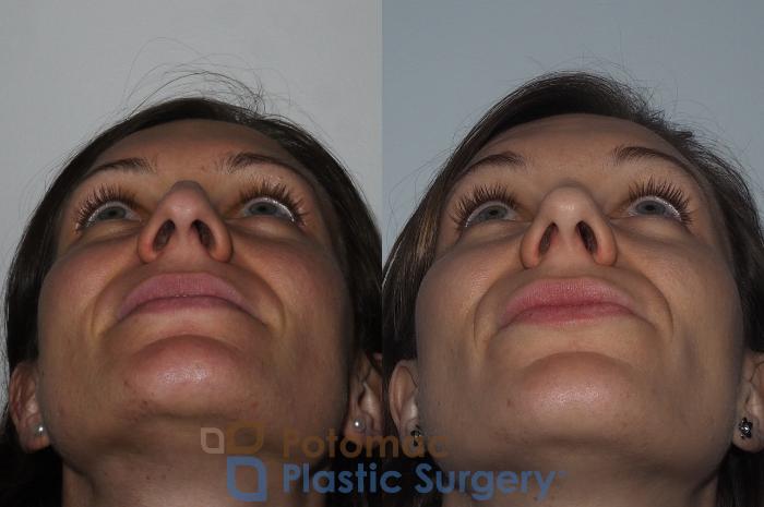 Before & After Rhinoplasty - Medical Case 220 Bottom View in Washington DC & Arlington , DC