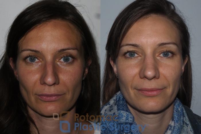 Before & After Rhinoplasty - Cosmetic Case 220 Front View in Washington DC & Arlington , DC