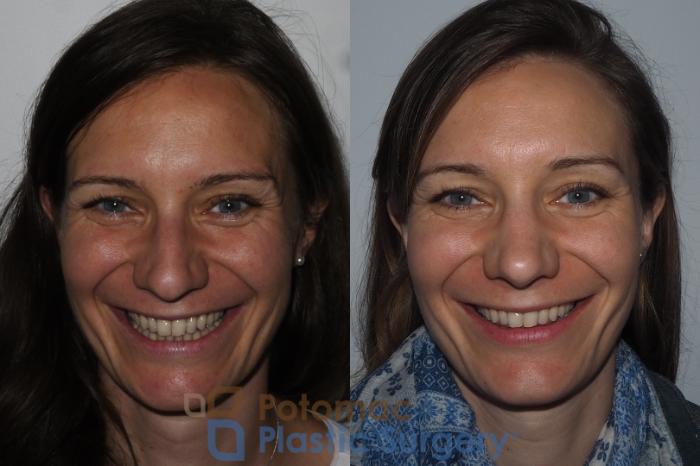 Before & After Rhinoplasty - Medical Case 220 Front View #2 View in Washington DC & Arlington , DC