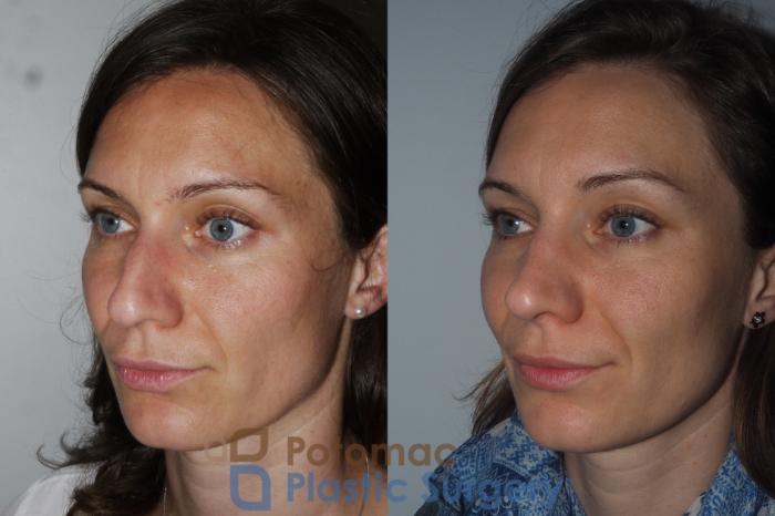 Before & After Rhinoplasty - Cosmetic Case 220 Left Oblique View in Washington DC & Arlington , DC