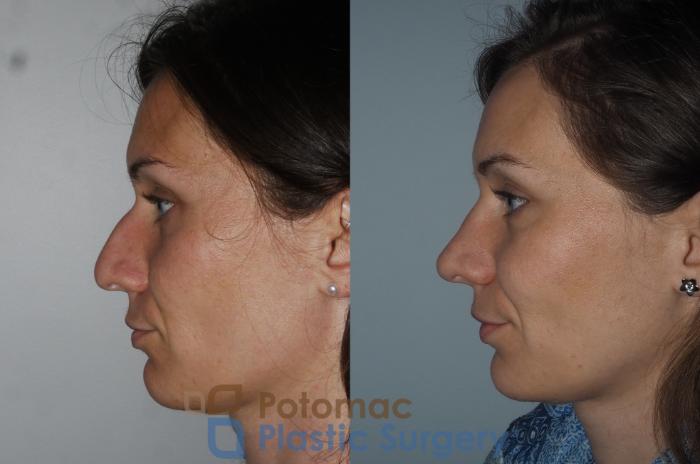 Before & After Rhinoplasty - Medical Case 220 Left Side View in Washington DC & Arlington , DC