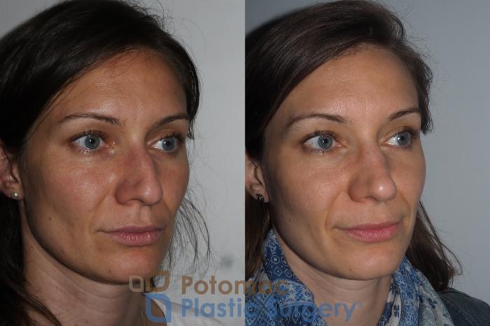 Before & After Rhinoplasty - Medical Case 220 Right Oblique View in Washington DC & Arlington , DC
