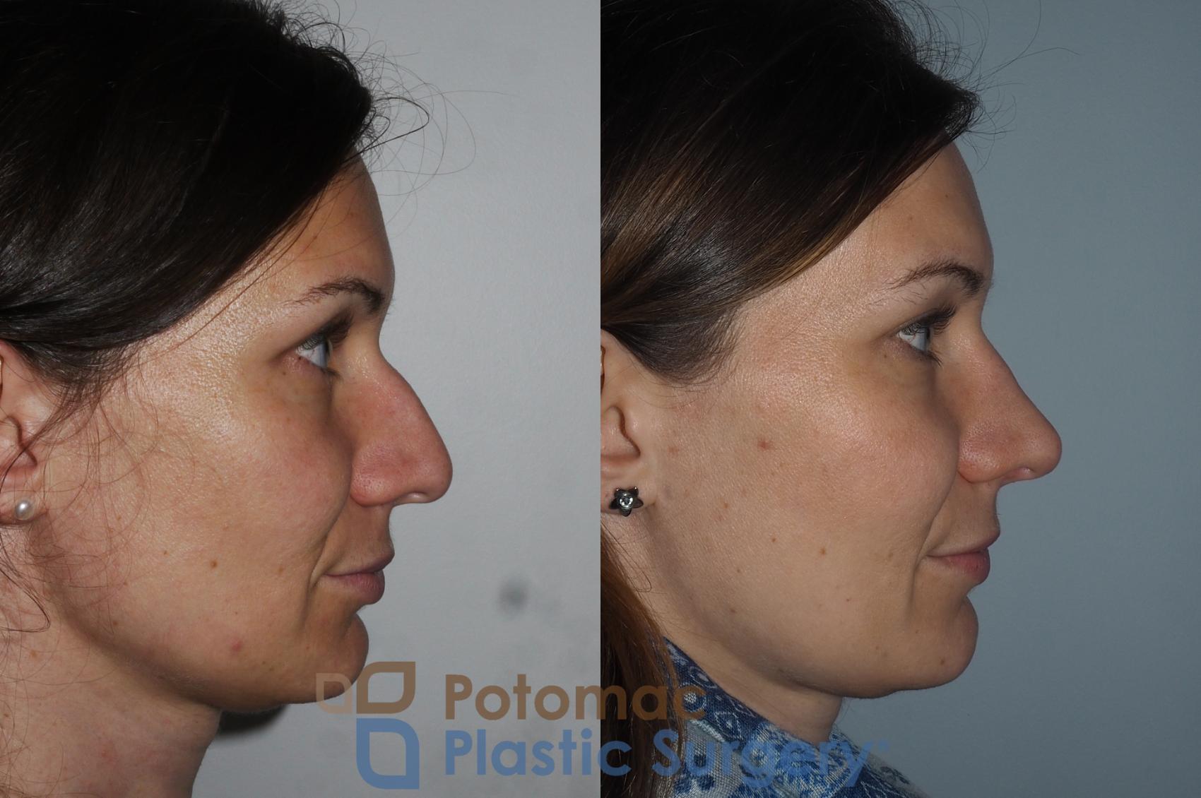 Before & After Rhinoplasty - Cosmetic Case 220 Right Side View in Washington DC & Arlington , DC