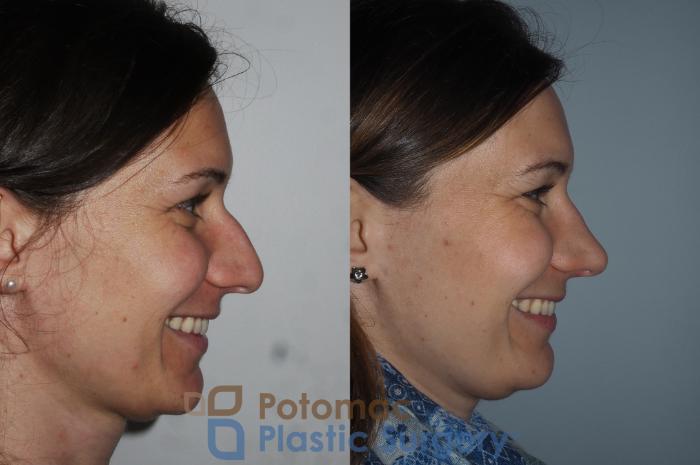 Before & After Rhinoplasty - Medical Case 220 Right Side View #2 View in Washington DC & Arlington , DC