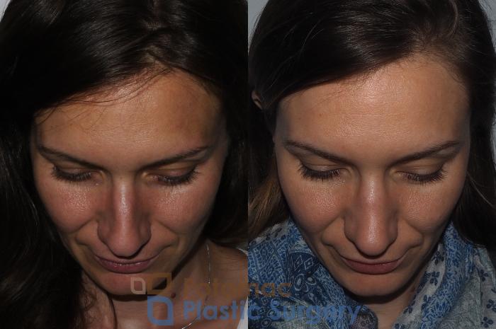 Before & After Rhinoplasty - Medical Case 220 Top View in Washington DC & Arlington , DC