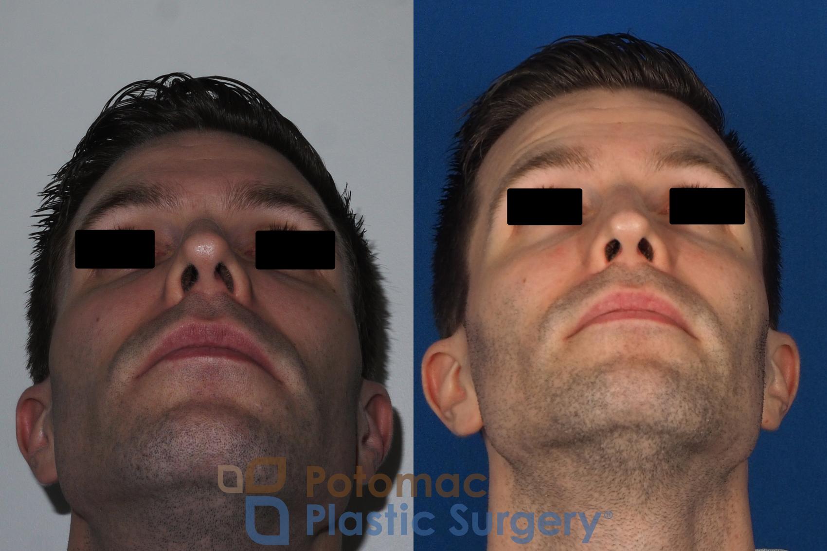 Before & After Rhinoplasty - Cosmetic Case 226 Bottom View in Washington, DC