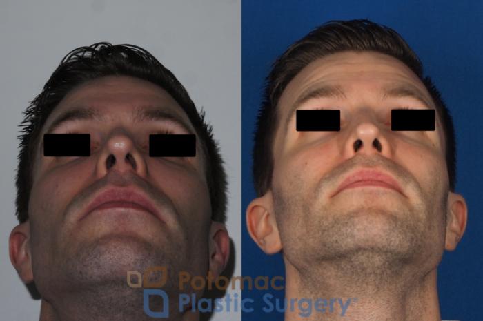 Before & After Dermal Fillers Case 226 Bottom View in Washington, DC