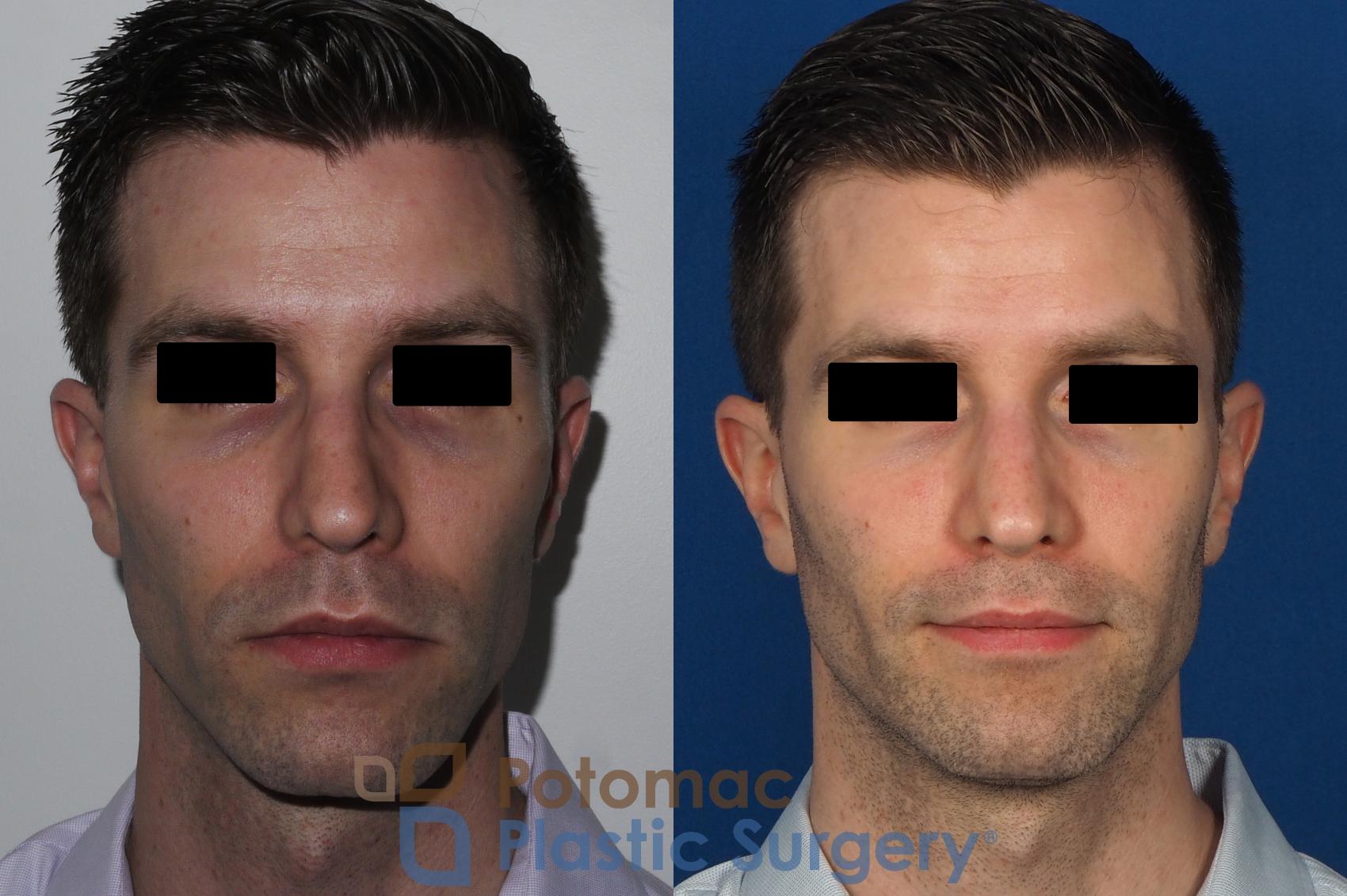 Before & After Rhinoplasty - Cosmetic Case 226 Front View in Washington DC & Arlington , DC