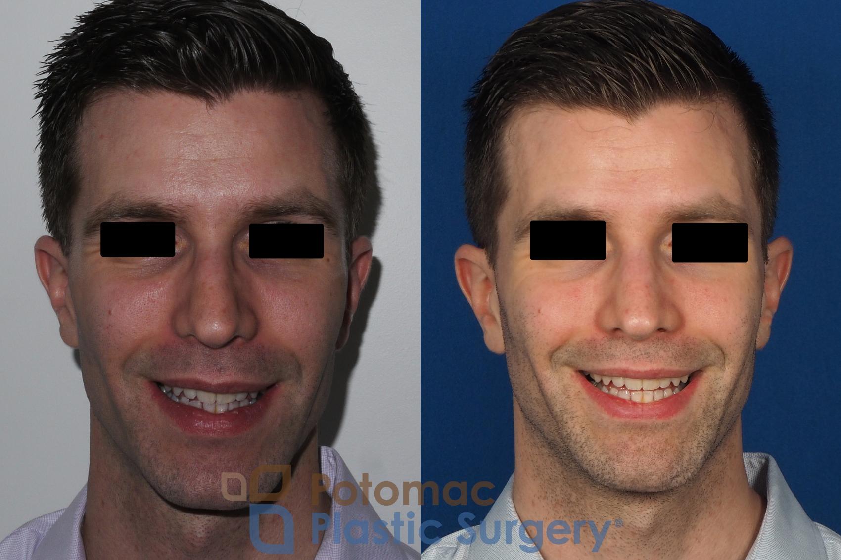Before & After Rhinoplasty - Cosmetic Case 226 Front View #2 View in Washington, DC