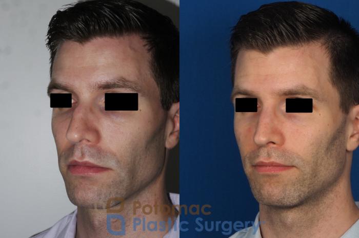Before & After Rhinoplasty - Medical Case 226 Left Oblique View in Washington DC & Arlington , DC