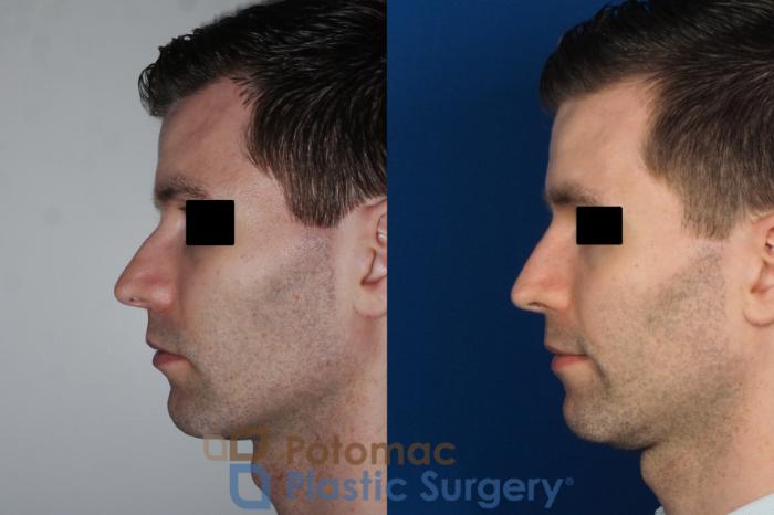 Before & After Rhinoplasty - Medical Case 226 Left Side View in Washington DC & Arlington , DC