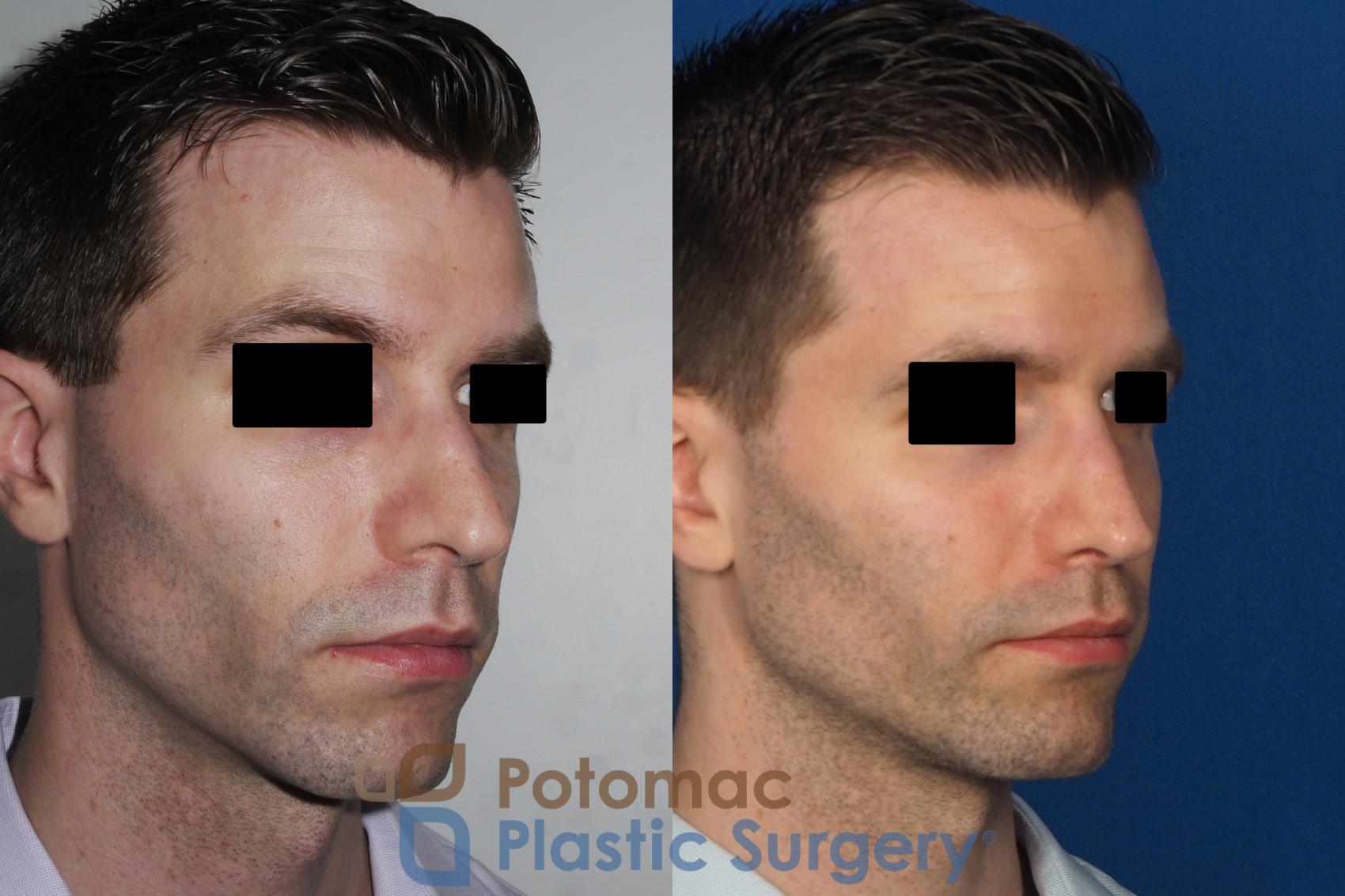Before & After Rhinoplasty - Cosmetic Case 226 Right Oblique View in Washington, DC