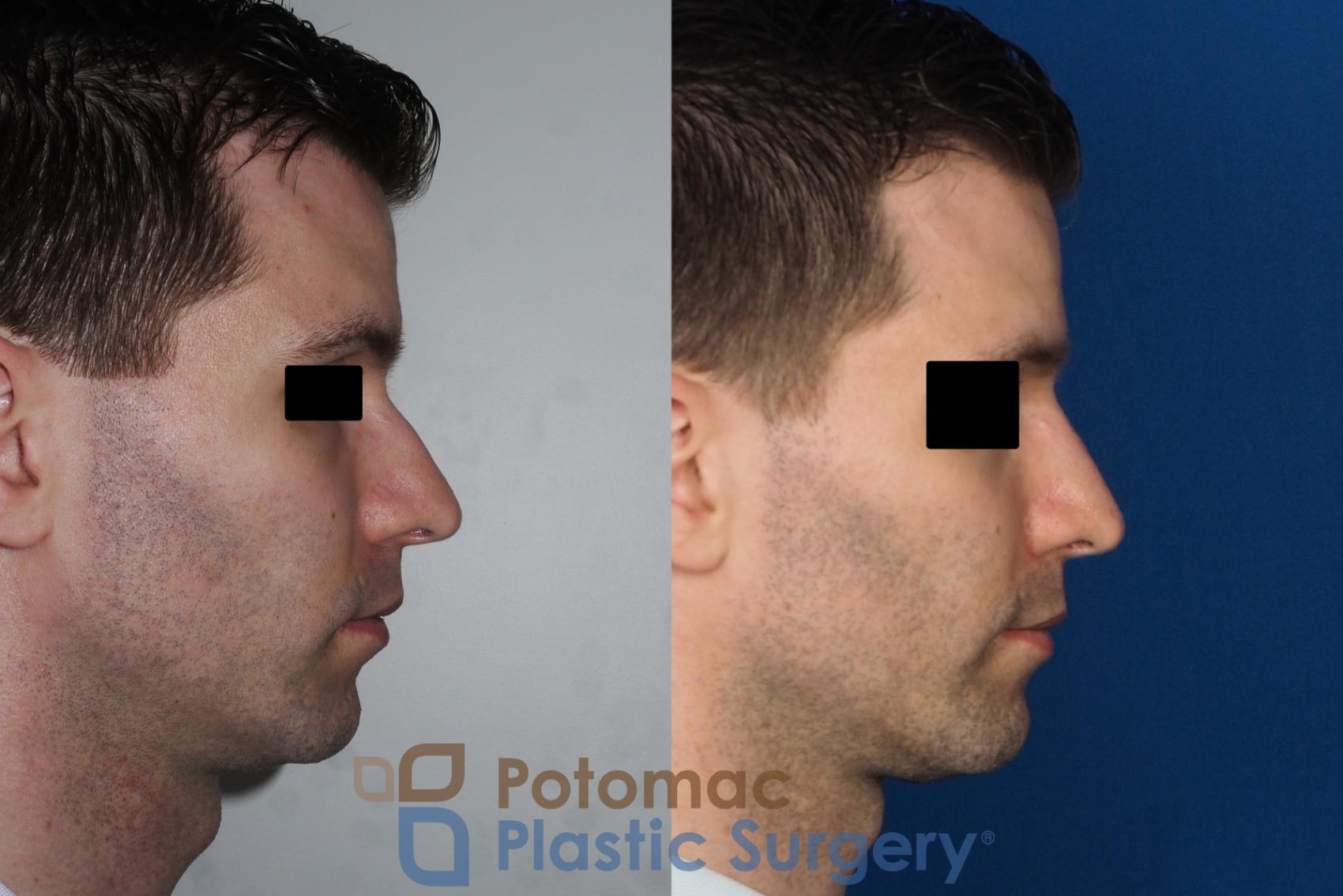 Before & After Rhinoplasty - Cosmetic Case 226 Right Side View in Washington, DC